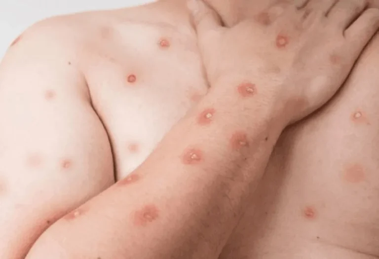 Ministério da Saúde confirma 140 casos de Mpox no Brasil em 2026